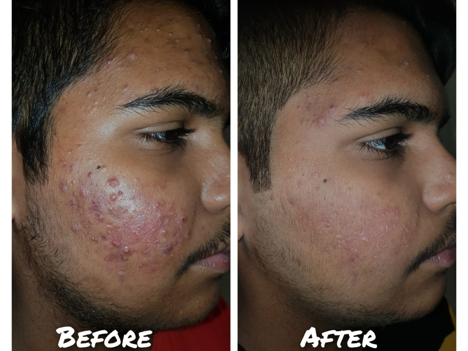 Acne treatment in Agra by Dr. Ishita at Divine Skin Clinic