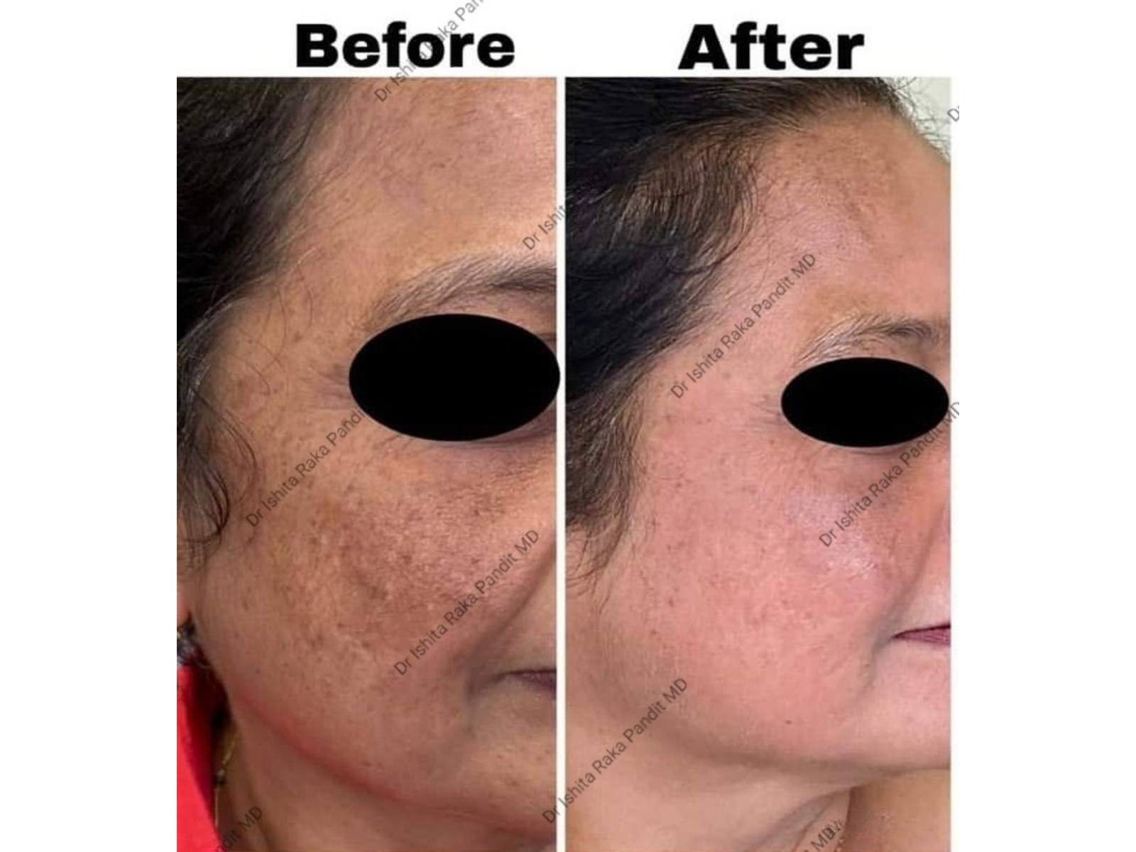 Melasma vs Hyperpigmentation treatment guidance by Dr. Ishita at Divine Skin Clinic, Agra