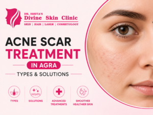 Acne Scar Treatment in Agra