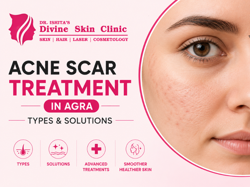 Acne Scar Treatment in Agra