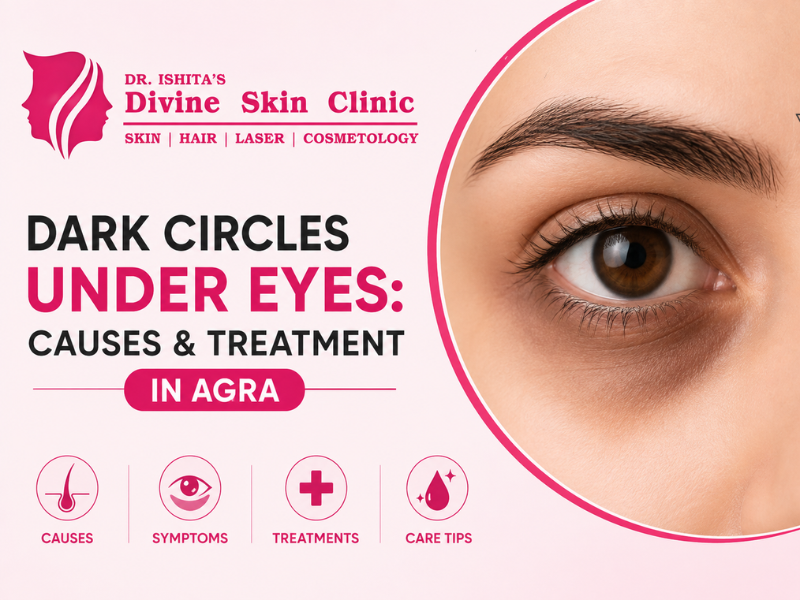 Dark Circles Under Eyes in Agra
