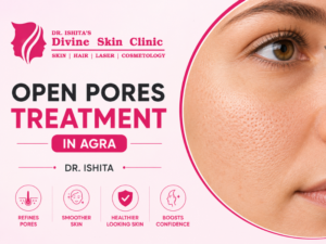 Open Pores Treatment in Agra