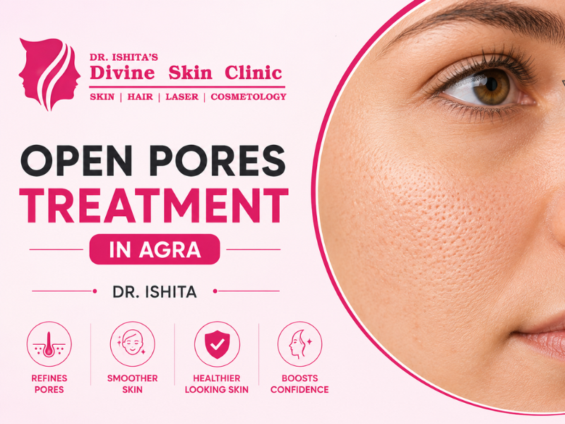 Open Pores Treatment in Agra