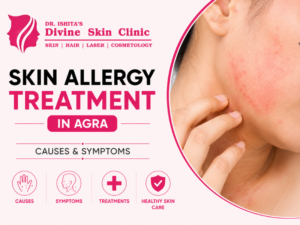 Skin Allergy Treatment in Agra
