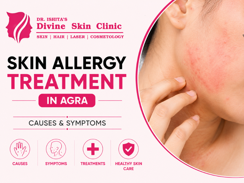 Skin Allergy Treatment in Agra