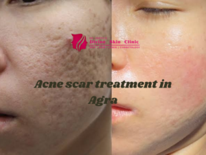 acne scar treatment in Agra