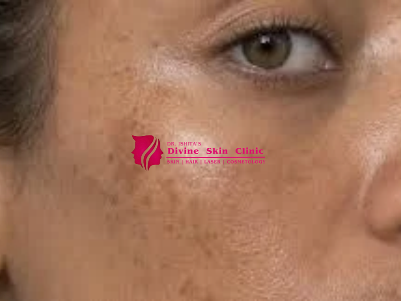 Melasma Treatment in Agra: Causes, Treatment Options & Prevention